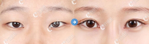 韩国必妩整形外科双眼皮案例