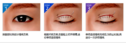  埋线双眼皮恢复期能正常工作吗?韩国必妩自然双眼神奇之处