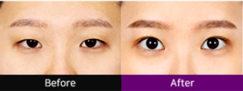 韩国必妩整形医院郑喆院长埋线双眼皮术前术后对比图