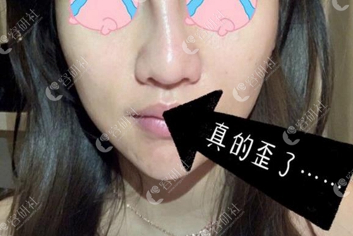 做完鼻综合反倒变歪鼻?玉芭和清新整形外科教你如何避雷！