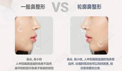 玉芭整形外科医院一般鼻整形和轮廓鼻整形的区别
