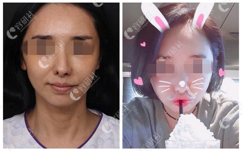 韩国清新整形外科医院鼻修复案例
