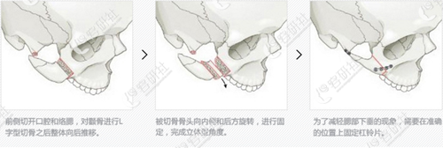 韩国原辰整形医院颧骨手术方式