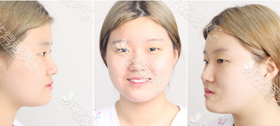 韩国K整形医院隆鼻术前实拍图