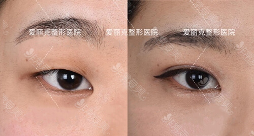 韩国医生梁海元双眼皮手术前后对比图