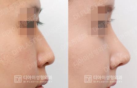 韩国DI整形外科鼻综合手术案例
