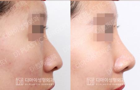 韩国DI整形外科驼峰鼻矫正案例