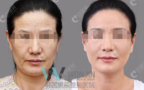 韩国原辰整形外科医院面部脂肪填充前后对比