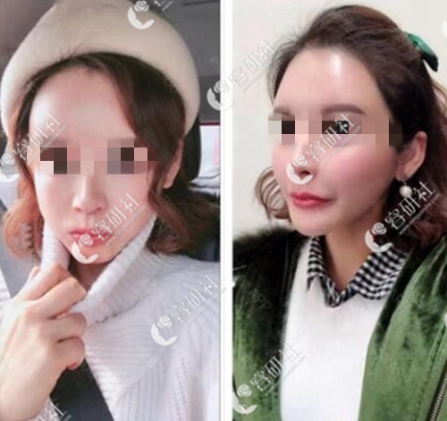 在韩国宝士丽整形医院做鼻基底手术后1个月