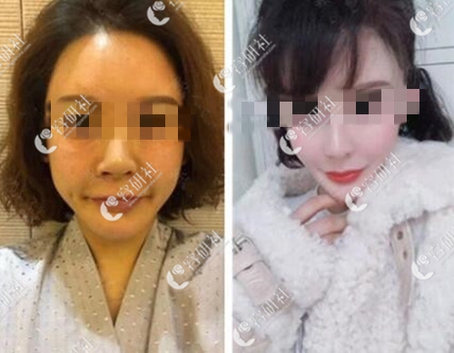在韩国宝士丽整形医院做鼻基底手术后3个月和术前对比
