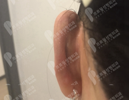 韩国profile普罗菲耳整形医院招风耳矫正术后疤痕