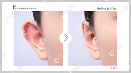 韩国profile普罗菲耳整形医院招风耳耳朵矫正案例