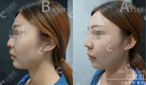 韩国首尔丽格皮肤科医院玻尿酸隆鼻案例