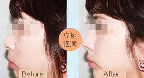 韩国TheOne综合整形医院玻尿酸隆鼻术前术后对比照