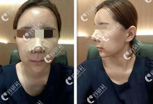 在韩国DA整形外科做隆鼻术后第三天