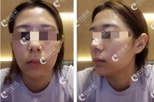 在韩国DA整形外科做隆鼻手术前