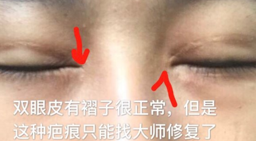 眼距宽开眼角得开特别大?爱护和纽莱茵医院为你深度解密!