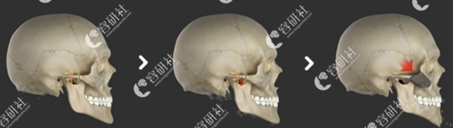 韩国普遍医院在用的L型颧骨截骨手术