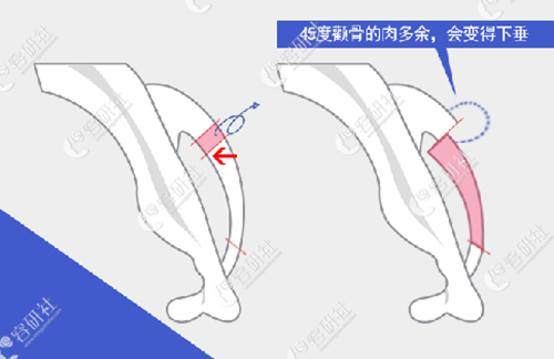 普通L型截骨手术的颧骨手术方式