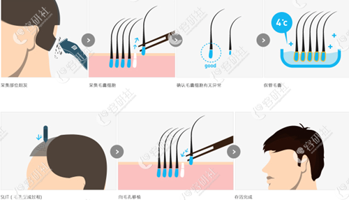 江南NHI植發(fā)醫(yī)院強化非切開方式—FUE2