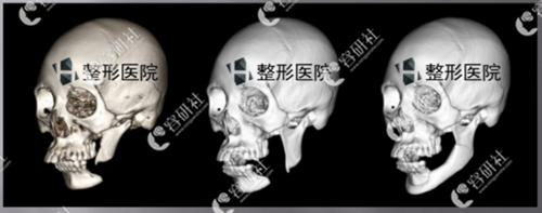 韩国H白汀桓整形外科面部轮廓骨骼修复案例