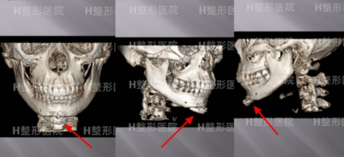 韓國(guó)H白汀桓整形外科下巴修復(fù)手術(shù)術(shù)前ct