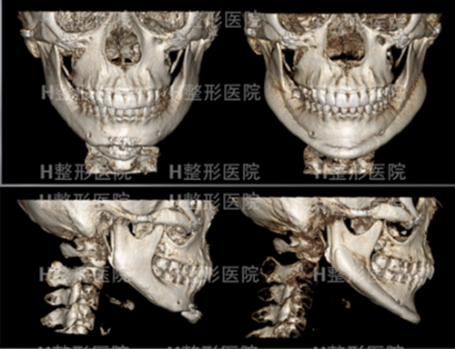 韩国H白汀桓整形外科下巴修复手术案例术前术后对比