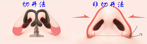 切开法和非切开法缩小鼻翼的区别