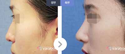 韩国芭啦本整形外科隆鼻案例图