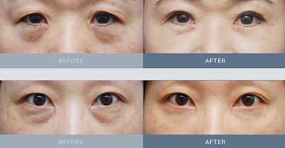 韩国TAKO达刻整形外科眼部年轻化案例