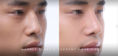 韩国玛博尔整形外科驼峰鼻矫正手术对比案例