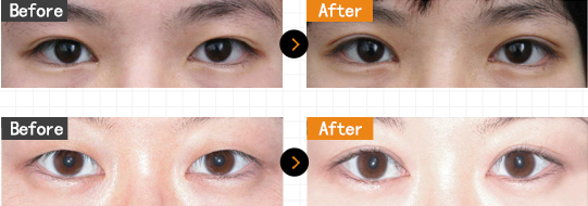 韩国玛博尔整形外科双眼皮术手术对比案例
