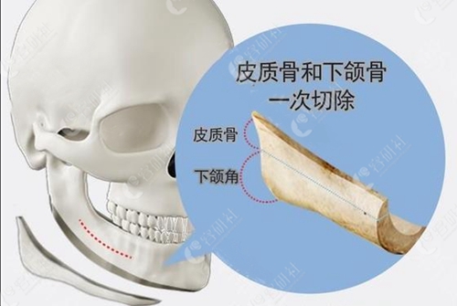 绮林整形外科医院轮廓术施术方法