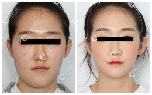 韩国创造美面部轮廓整形医院轮廓术前术后对比照