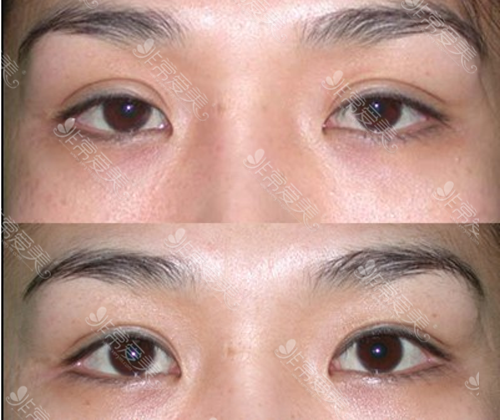 曹仁昌包眼角做的厉害吗?修复眼角疤痕、露红案例效果怎样?