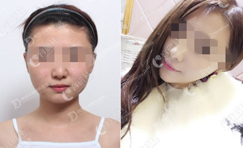 韩国女神整形外科轮廓手术案例