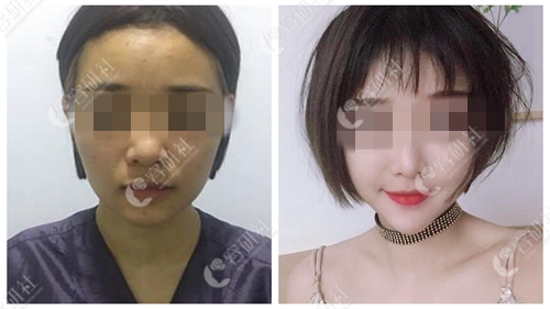 韩国女神整形外科面部轮廓术前术后对比照