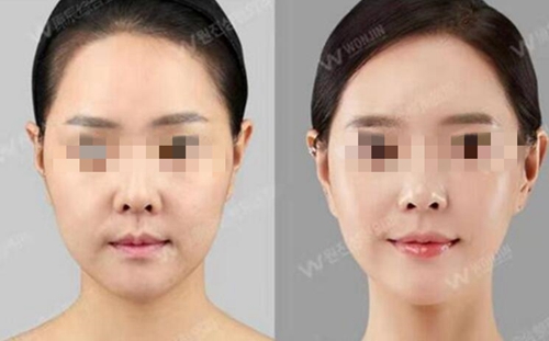 韩国原辰整形外科面部脂肪填充案例