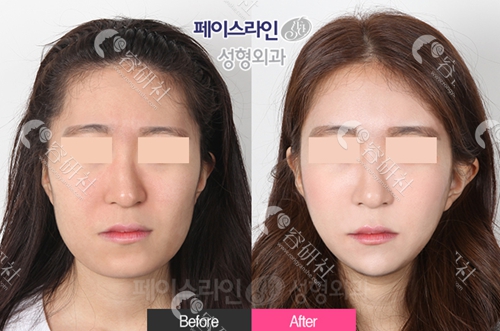 韩国菲斯莱茵整形外科面部轮廓改善案例