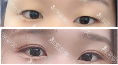韩国医院割双眼皮一般是多宽 太宽了想要变窄难度大不大？