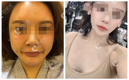 韩国宝士丽医院鼻基底手术案例