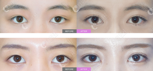 韩国秀美颜整形外科双眼皮整形案例