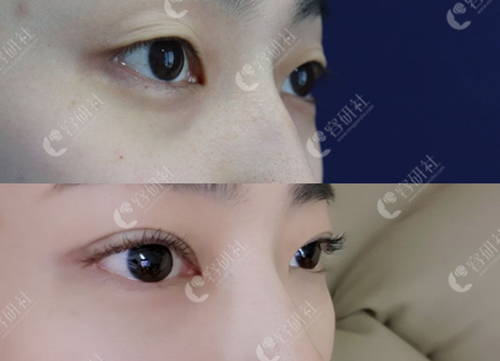 韩国纯真整形外科双眼皮术前术后对比
