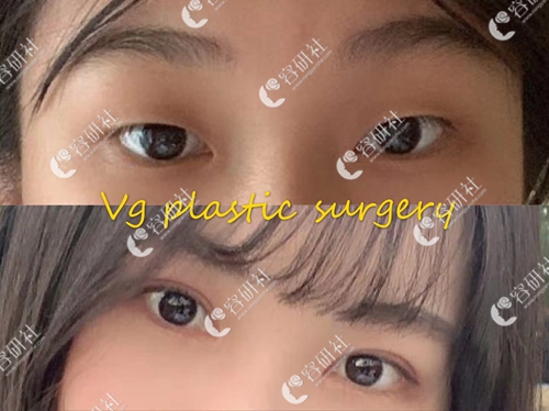 VG整形外科双眼皮手术案例