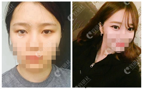 韩国秀美颜整形外科双眼皮修复案例