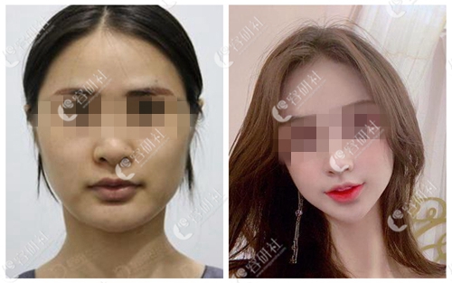韩国女神整形外科轮廓案例