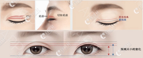 韩国爱丽克面部轮廓眼部整形医院眼睛修复技术