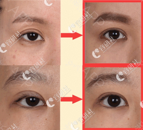 韩国爱丽克梁海元院长肉条眼眼睛修复手术案例