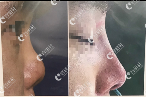 韩国glory整形医院挛缩鼻修复手术案例