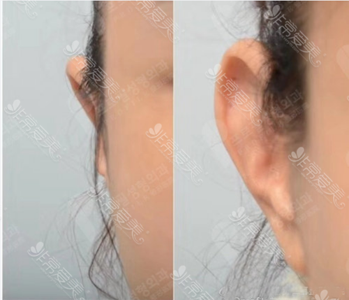 贴脑耳整形方案曝光，改善看不到耳朵效果显著！
